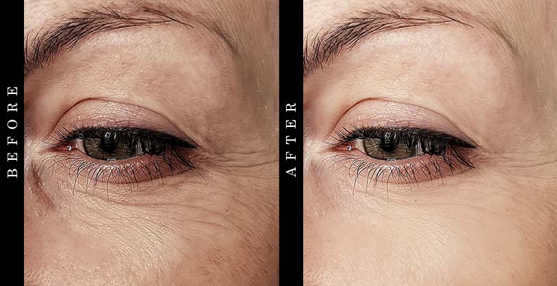 drmtlgy-eye-cream-before-after
