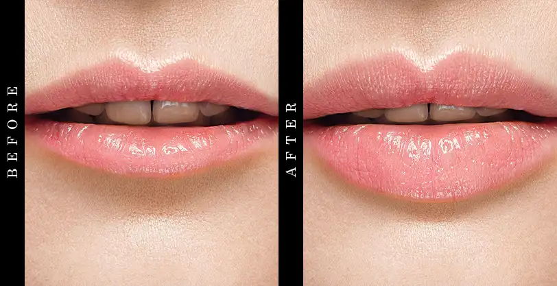 Beverly Hills MD Anti-Aging Lip Enhancer Before and After