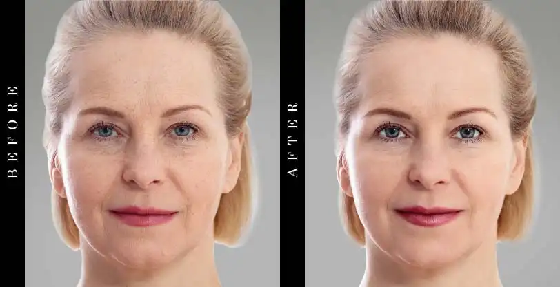 beverly-hills-md-deep-wrinkle-filler-before-after