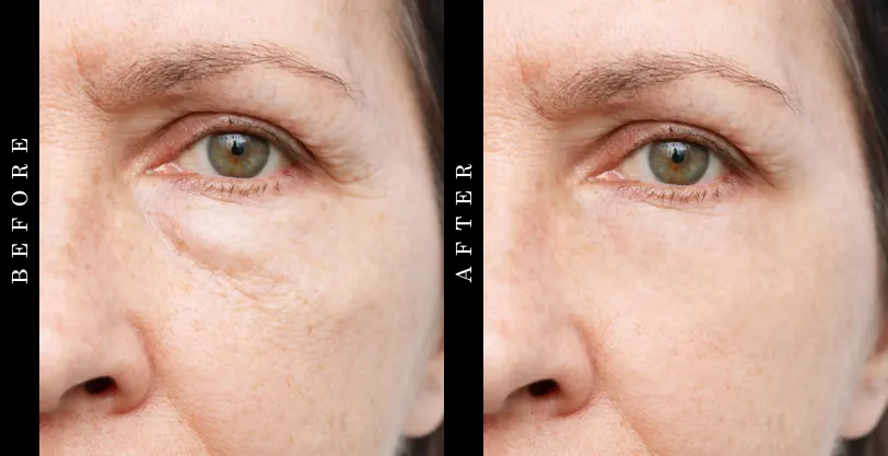 BioSkin Youth Complex Before and After
