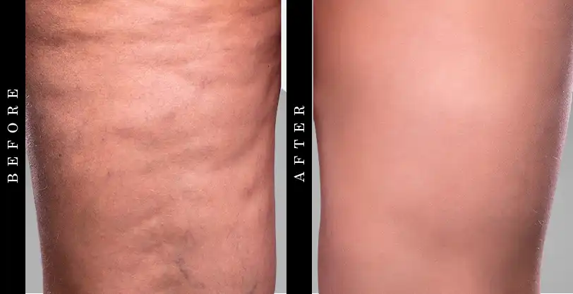 Cellinea Before and After