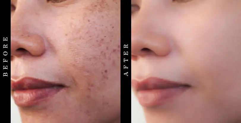 Dermefface Fx7 Before and After