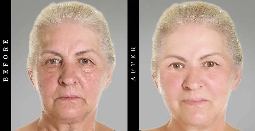 Dermelect Wrinkle Treatment Before and After