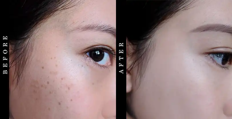 DRMTLGY Microdermabrasion Scrub Before and After
