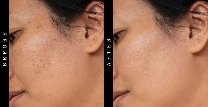 Polyphenol Dark Spot Diminisher Before and After