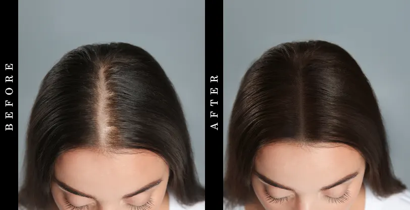 KeraNew Before and After