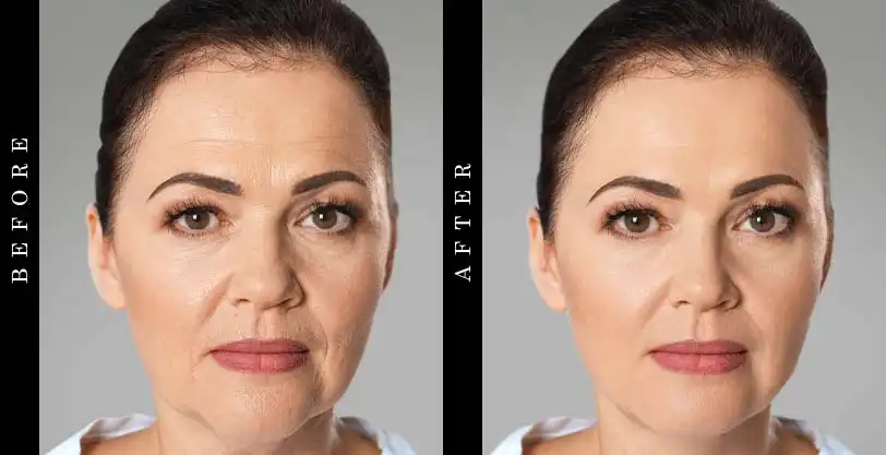 kollagen-intensiv-before-after