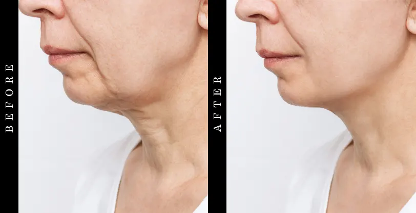 Rapid-Lift Advanced Neck Serum Before and After