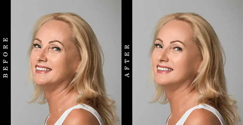 Serious Skincare Insta Tox Before and After