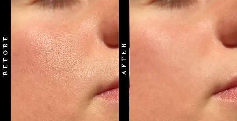SkinCeuticals LHA Cleansing Gel Before and After
