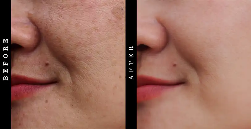 Skinception Illuminatural 6i Before and After