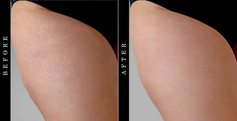 Skinception Intensive Stretch Mark Therapy Before and After