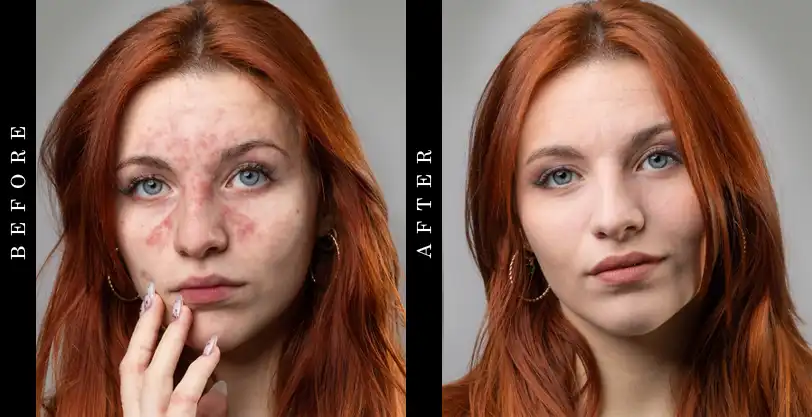 Skinception Rosacea Treatment Before and After
