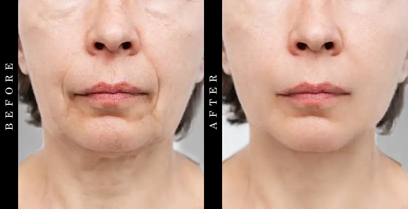 SkinCeuticals C E Ferulic Serum Before and After