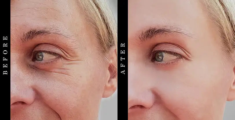 SkinCeuticals Hyaluronic Acid Intensifier Before and After