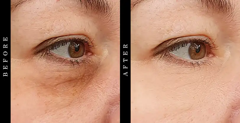 Metacell Renewal B3 Before and After