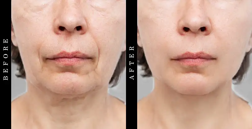 Skinceuticals Phloretin CF Before and After