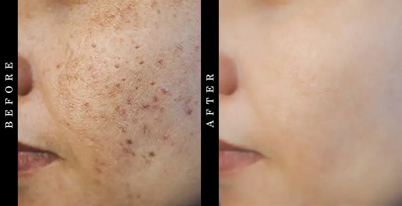 tru-alechemy-spot-check-before & after